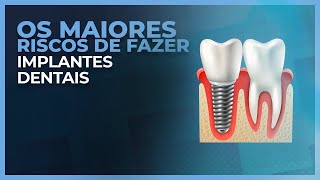 RISCOS DE SE FAZER IMPLANTES DENTÁRIOS [upl. by Anastassia803]