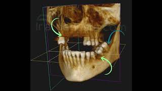 ¿Por qué te piden una tomografía dental [upl. by Yeltihw901]