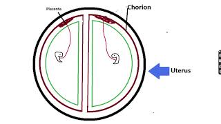 Twin Pregnancy Dichorionic Diamniotic Monochorionic Diamniotic etc MamaDoctorJones [upl. by Stephine]