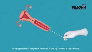 Pregna Accurette  Endometrial Biopsy Curette Usage Procedure Guide Endometrialbiopsy [upl. by Hamish321]