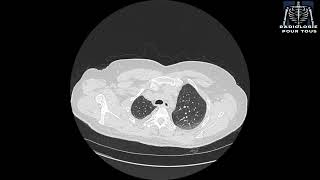 SCANNER THORACIQUE  Pleurésie bilatérale déjà traité pour TBK pulmonaire [upl. by Crescentia17]