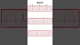 Premature ContractionsBigeminy Trigeminy QuadrigeminyECGMadeEasy ecg doctor medicine cardio [upl. by Collete]