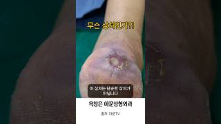 무슨 상처 인가 발뒤꿈치 욕창 소독 치료 병원 성형외과 bedsore pressure sore dressing seoul korea아문TV [upl. by Zsa Zsa]