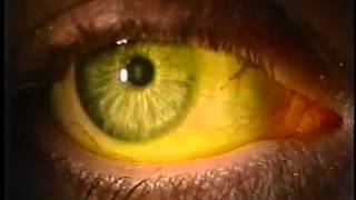 Instilling Fluorescein Dye in the Eye [upl. by Akiehsat]