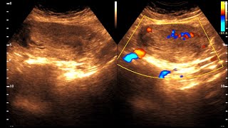 Partial Molar Pregnancy  GESTATIONAL TROPHOBLASTIC  Hydatidiform Molar Pregnancy NEOPLASIA [upl. by Boswall]