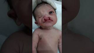 How to cleft lip and palate baby  newborn  banitkevlogs4972 [upl. by Keegan]