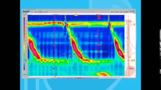 Esophageal Motility Disorders Part 1 [upl. by Martineau]