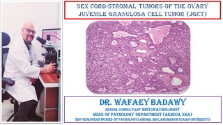 SEX CORD STROMAL TUMORS OF THE OVARY JUVENILE GRANULOSA CELL TUMO BY DR WAFAEY BADAWY [upl. by Sallyann855]