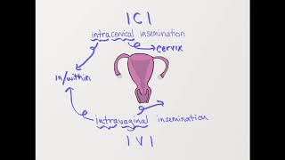 What is ICI Intracervical insemination [upl. by Turnbull]