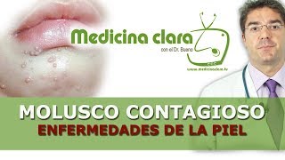 Enfermedades piel Molusco contagioso pápulas perladas granos en niños [upl. by Nasia]