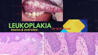 Leukoplakia histopathology [upl. by Avrit]