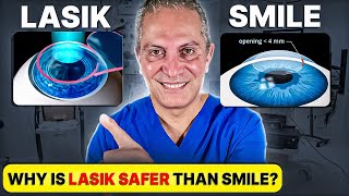 Should you Choose LASIK or SMILE Eye Surgery Eye Surgeon Explains [upl. by Allez]