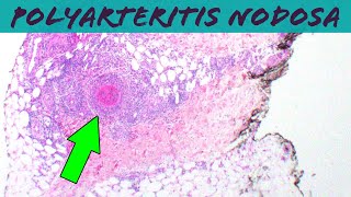 Polyarteritis Nodosa vasculitis pathology dermpath dermatology usmle dermatopathology [upl. by Ajiam]