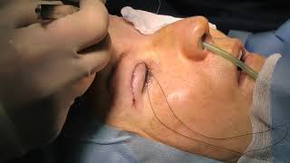 Suturing of upper lid blepharoplasty [upl. by Imnubulo]