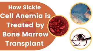 How Sickle Cell Anemia Is Treated by Bone Marrow Transplant [upl. by Rramal]