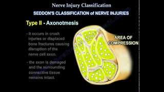 Nerve Injury types  Nerve recovery  Everything You Need To Know  Dr Nabil Ebraheim [upl. by Catrina]