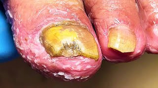 Nail fungus has spread all over my foot Very painful【Mr Lin Toenail】pedicure stressrelief nail [upl. by Odama]