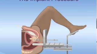 Brachytherapy for Prostate Cancer [upl. by Kamillah]