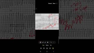 Afib with wpw ecg explanation [upl. by Montfort436]