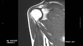 MR undersøkelse av skulder Normal [upl. by Secilu464]