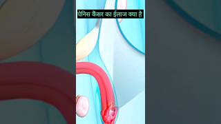 Penile Cancer Treatment health healthy facts [upl. by Kooima]