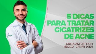 5 Dicas para tratar Cicatrizes de Acne  Dr Lucas Fustinoni  Médico  CRMPR 30155 [upl. by Releyks]