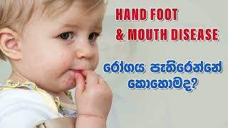 Hand Foot Mouth Disease  දරුවා ආසාදනයවීම වළක්වා ගන්නේ කොහොමද [upl. by Reiners]