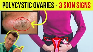 Doctor explains 3 SKIN SIGNS ASSOCIATED WITH POLYCYSTIC OVARIAN SYNDROME PCOS [upl. by Ahsienyt580]