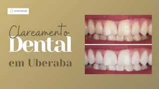 Clareamento Dental em Uberaba [upl. by Dottie]