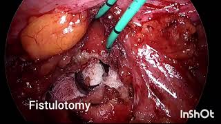 LAPAROSCOPIC VVF REPAIR [upl. by Aitsirhc]