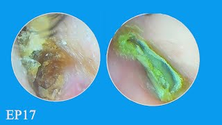 Hard and Impacted Ear Wax Removal Form Eardrum Ep17 asmr earwaxremoval [upl. by Allesig800]