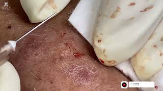 Big Cystic Acne Blackheads Extraction Blackheads amp Milia Whiteheads Removal Pimple Popping 2024 [upl. by Zimmermann]