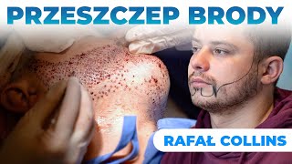 Przeszczep Brody w Turcji  Zobacz Cały Proces  Rafał Collins [upl. by Yekcor]