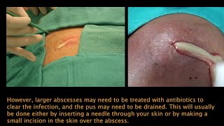 Abscess PEV [upl. by Priscilla]