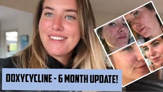 DOXYCYCLINE  6 month update ACNE JOURNEY [upl. by Carisa499]