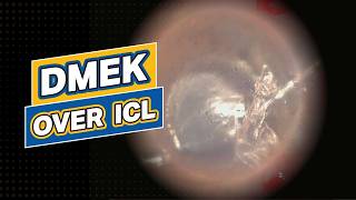 DMEK over ICL [upl. by Ellesij]