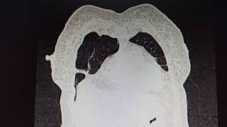 Multiple cavitary lesions with surrounding consolidation and ground glass opacification in left lung [upl. by Aydidey]