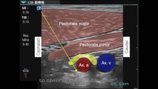 Brachial plexus infraclavicular approach [upl. by Ahtennek270]