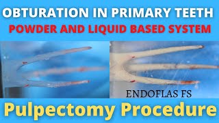 Obturation in Primary Teeth  Powder and Liquid Based Material  Pulpectomy Procedure [upl. by Aninnaig]