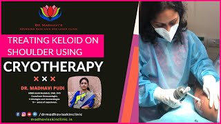 Keloids Treatment on Shoulder with Cryotherapy  Painless Cryotherapy Treatment  Dr Madhavi Pudi [upl. by Veljkov95]