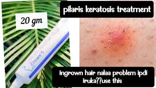 zitcare s salicylic acid gel review  pilaris keratosis treatment  acne [upl. by Ana]