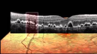 SPECTRALIS® Imaging Modalities SD OCT Red Free Infrared BluePeak ICG FA Scanning Heidelberg [upl. by Gove]