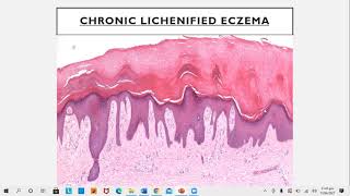 Lecture78 Eczematous disorders PartI Rooks chapter 39 [upl. by Llehcor]