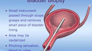 Cystoscopy [upl. by Mercola608]