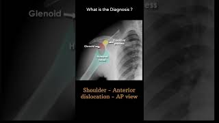 Shoulder Anterior dislocation AP view 104 Trauma Xray Upper limb gallery 1radiologychannel007 [upl. by Aznerol662]