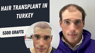 Hair Transplant in Turkey  Hair Transplant 5000 Grafts Process  Hair Transplant hairtransplant [upl. by Naynek]