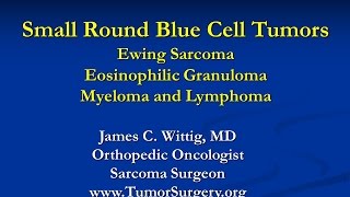 Orthopedic Oncology Course Small Round Blue Cell Tumors Ewing Sarcoma Lymphoma  Lecture 8 [upl. by Ennailuj]