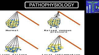 PULMONARY EDEMA [upl. by Ahsirahc]