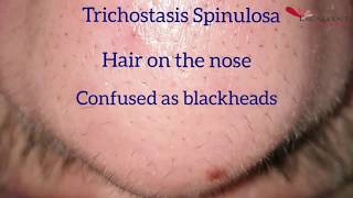 Hair removal on the nose by Laser  Trichostasis Spinulosa [upl. by Anaderol]