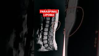 Paraspinal Lipoma mri shorts mriradiographer MRI Dorso Lumbar Spine  T1W Sequence [upl. by Fiel]